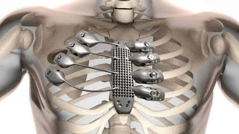 Solución de implante costal impresa en 3D. Fuente: ZME Science
El paciente tenía una carencia por resolver que el laboratorio 3D de RMC Innovation abordó mediante digitalización 3D.