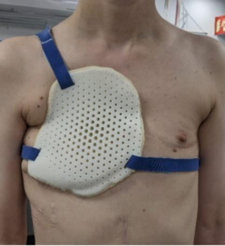 Creating a CustomFit Chest Protector with the EinScan H