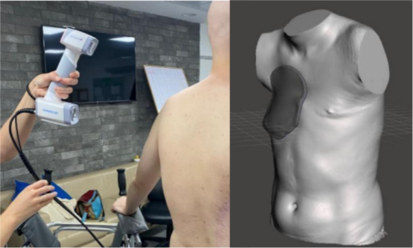 Escaneo con el EinScan H (izquierda); modelo 3D del cuerpo del paciente (derecha)